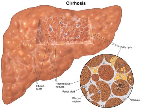 Cirrhosis .